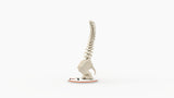 Scoliosis Type-2 Model 3