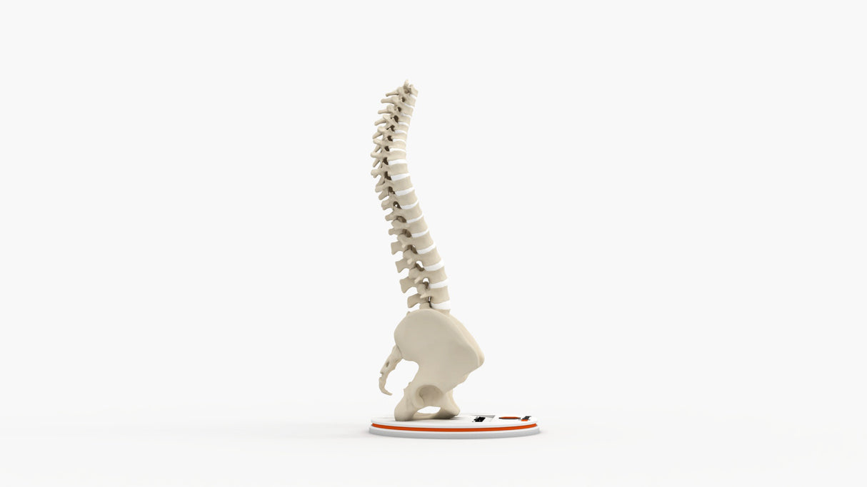 Scoliosis Type-2 Model 3