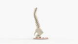 Scoliosis Type-2 Model 3
