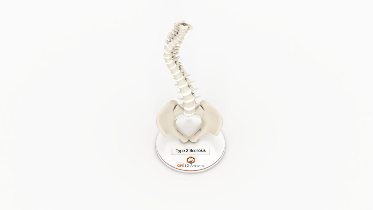 Scoliosis Type-2 Model 3