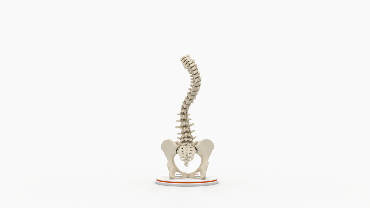 Scoliosis Type-2 Model 4