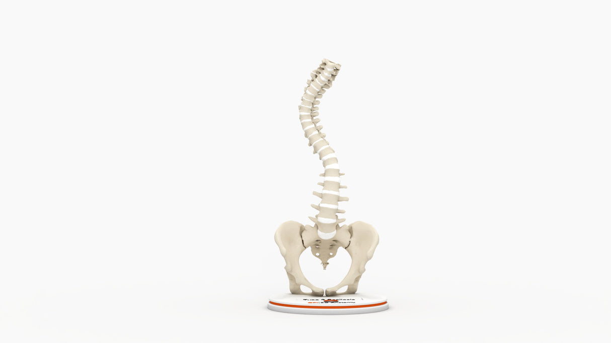 Scoliosis Type-2 Model 4