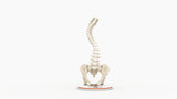 Scoliosis Type-2 Model 4
