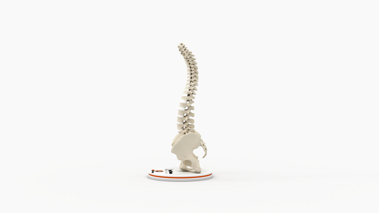 Scoliosis Type-2 Model 4