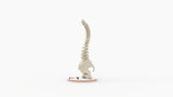 Scoliosis Type-2 Model 4