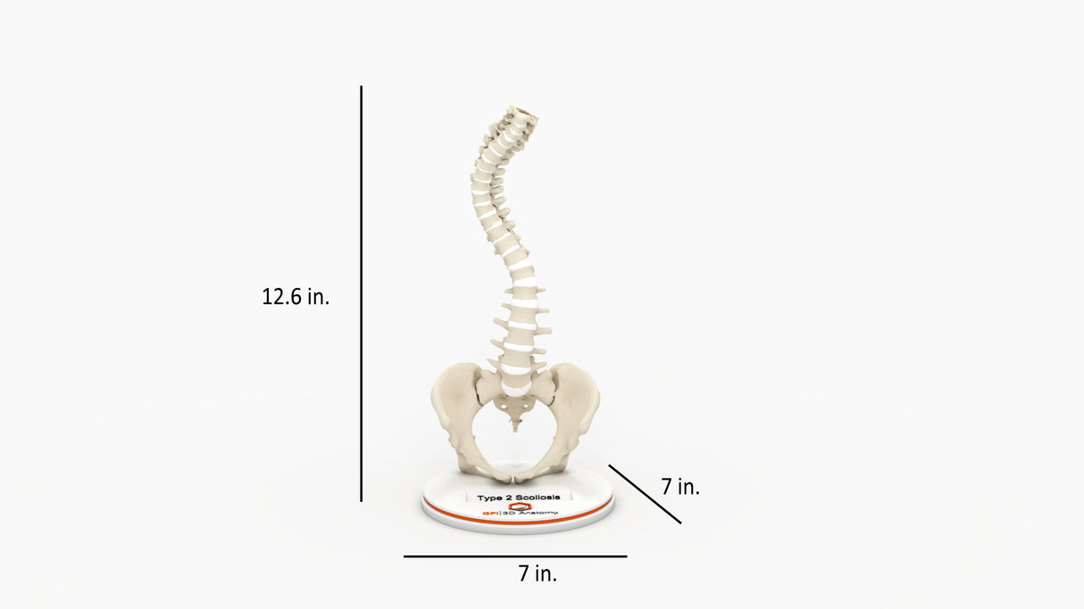 Scoliosis Type-2 Model 4