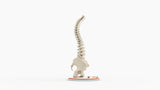 Scoliosis Type-2 Model 4