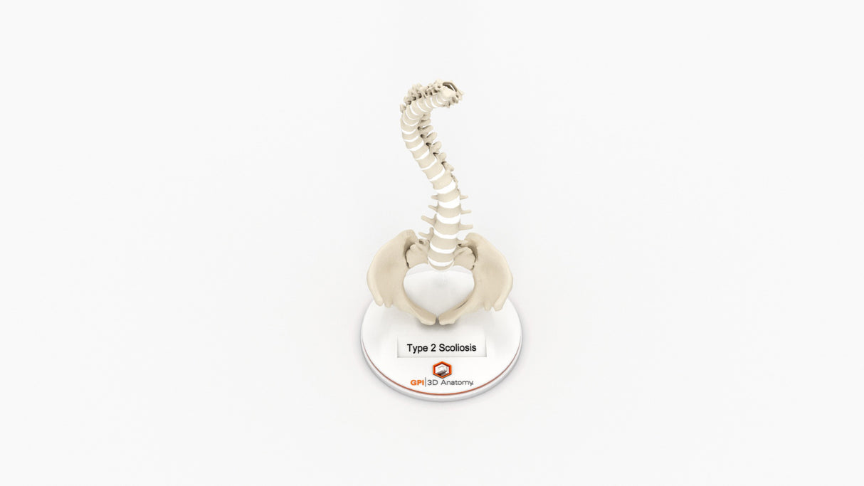 Scoliosis Type-2 Model 4