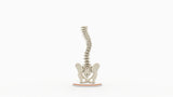 Scoliosis Type-2 Model 5