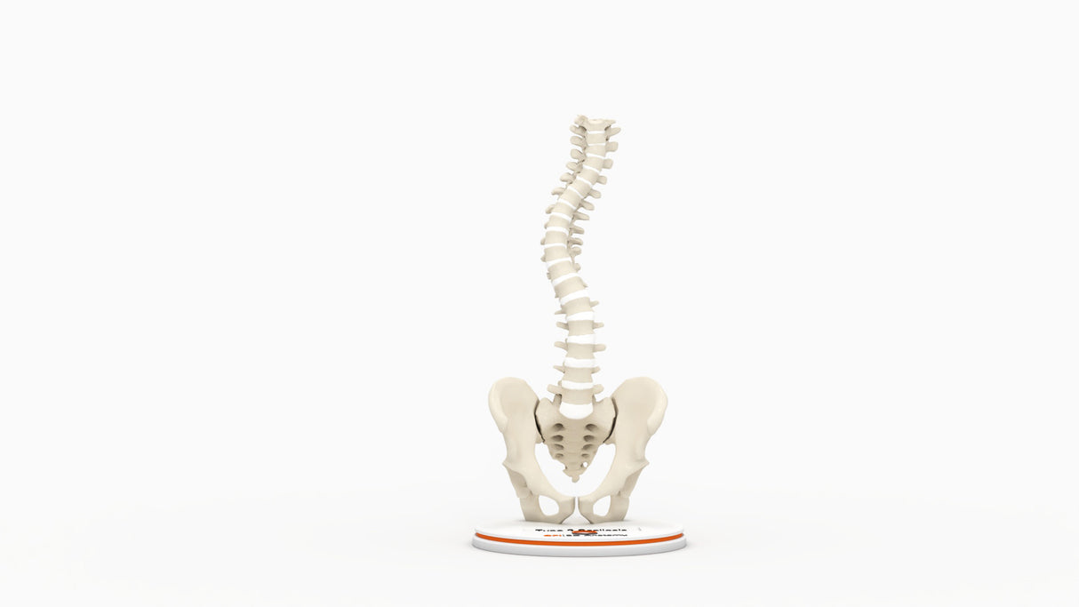 Scoliosis Type-2 Model 5