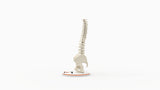 Scoliosis Type-2 Model 5