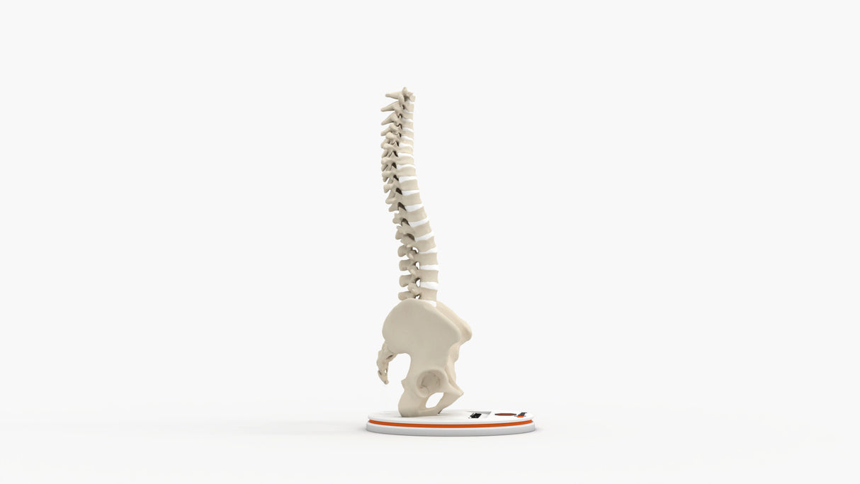 Scoliosis Type-2 Model 5