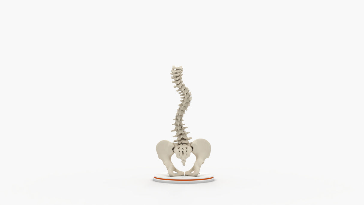 Scoliosis Type-2 Model 6