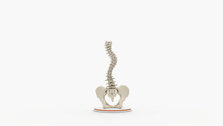 Scoliosis Type-2 Model 6