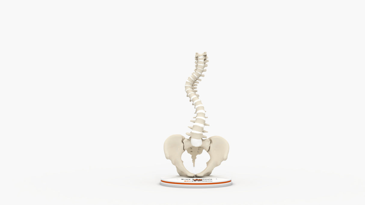 Scoliosis Type-2 Model 6