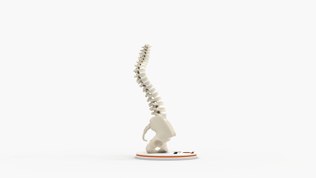 Scoliosis Type-2 Model 6