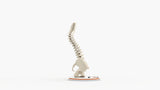 Scoliosis Type-2 Model 6