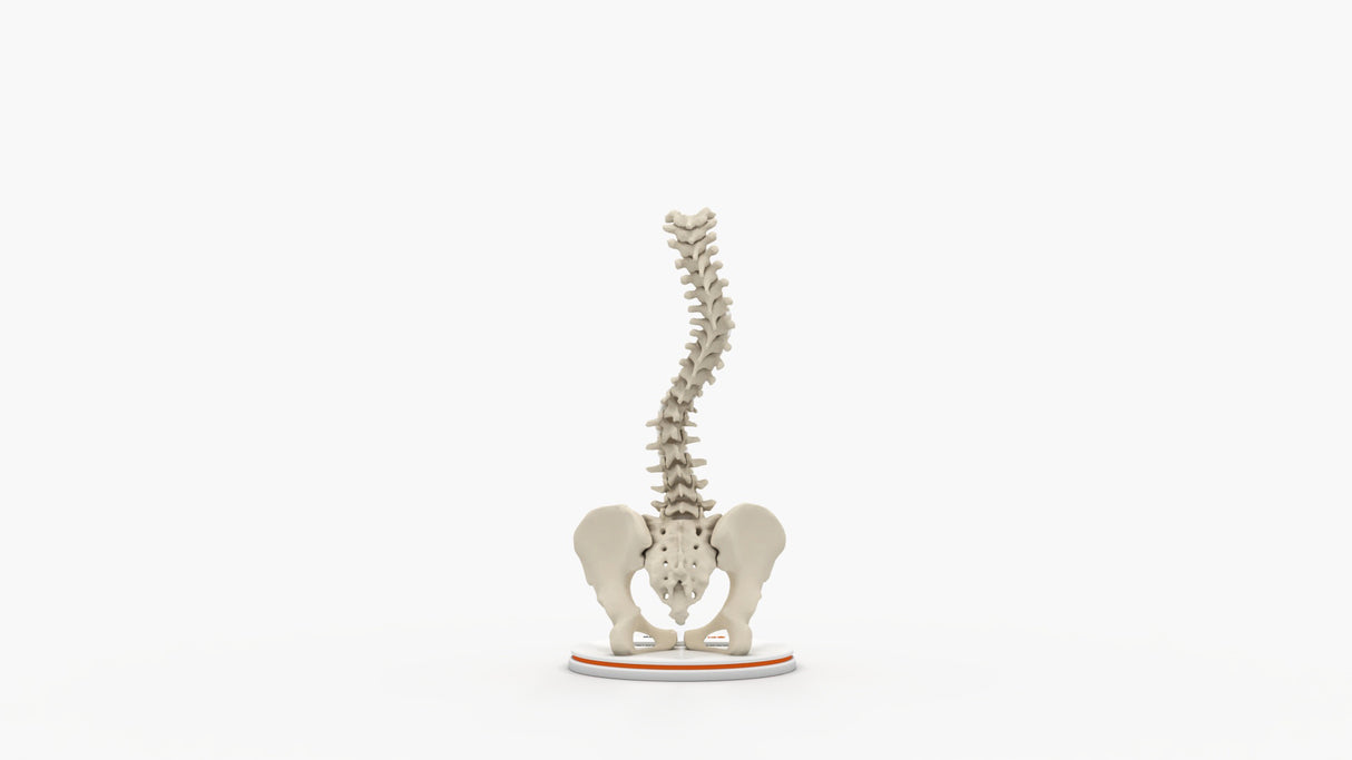Scoliosis Type-2 Model 7