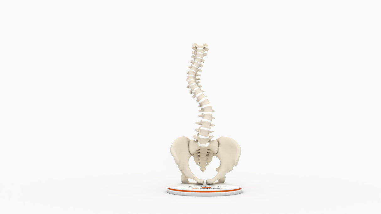 Scoliosis Type-2 Model 7