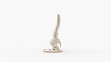 Scoliosis Type-2 Model 7
