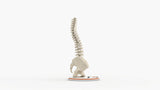 Scoliosis Type-2 Model 7