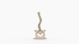 Scoliosis Type-2 Model 8