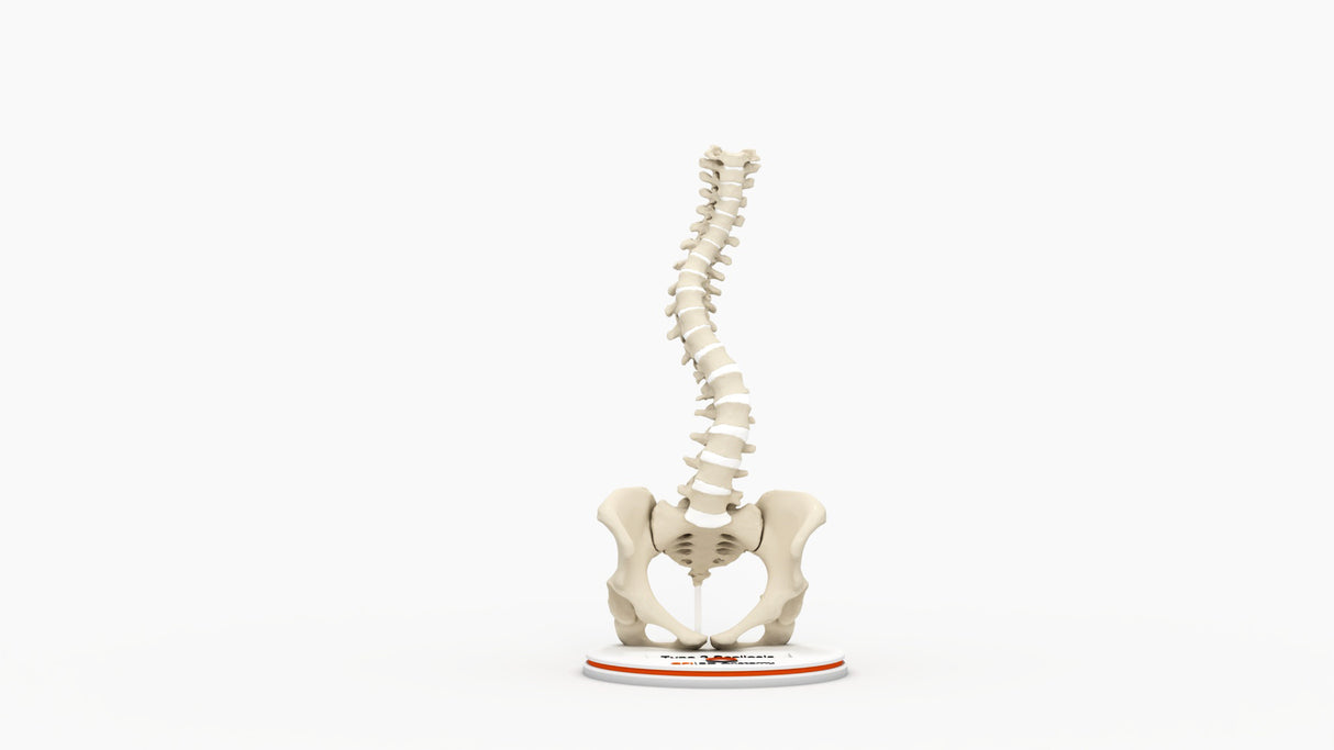 Scoliosis Type-2 Model 8