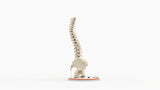 Scoliosis Type-2 Model 8