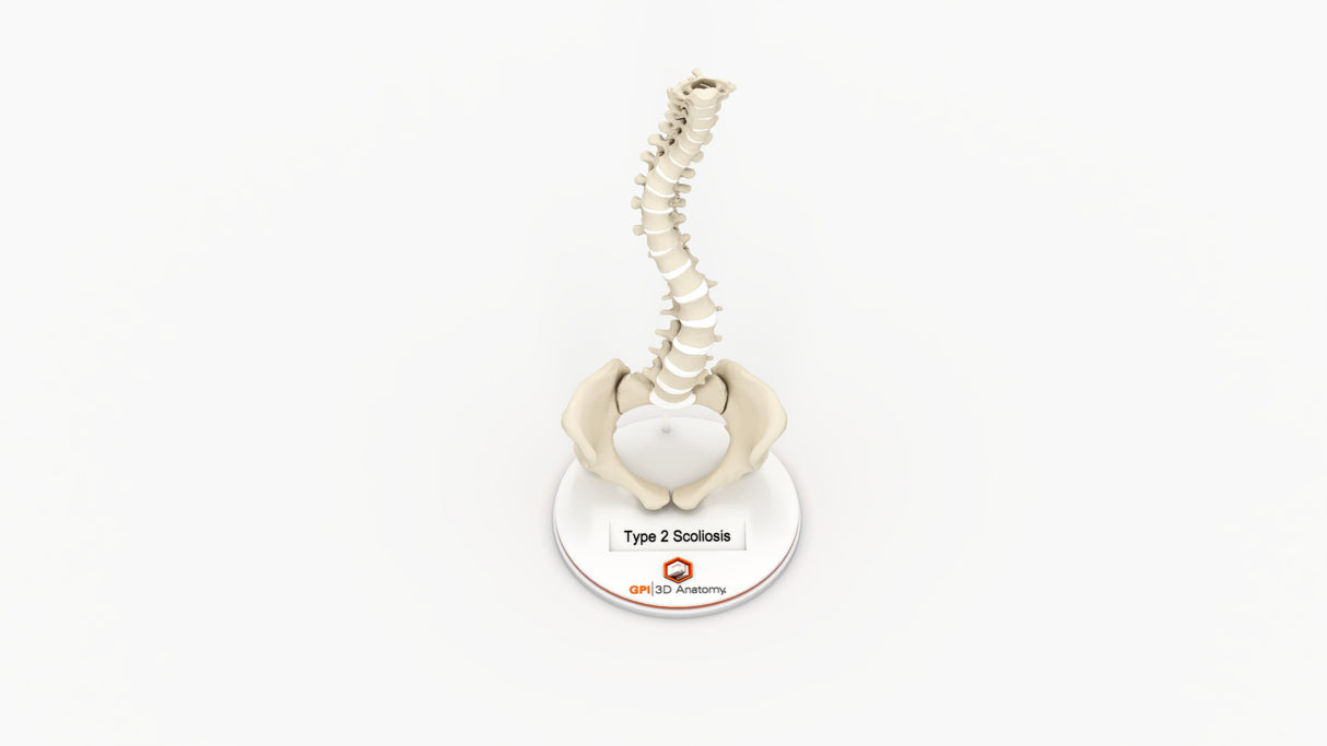 Scoliosis Type-2 Model 8