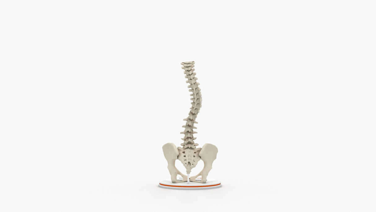 Scoliosis Type-2 Model 9