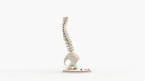 Scoliosis Type-2 Model 9