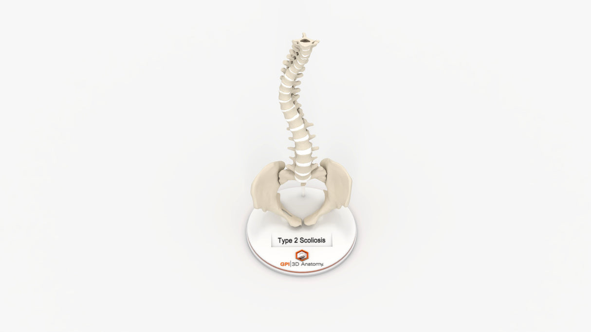 Scoliosis Type-2 Model 9