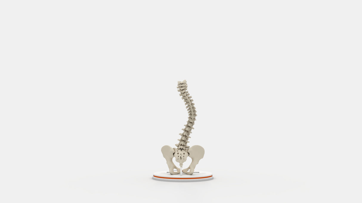 Scoliosis Type-3 Model 1