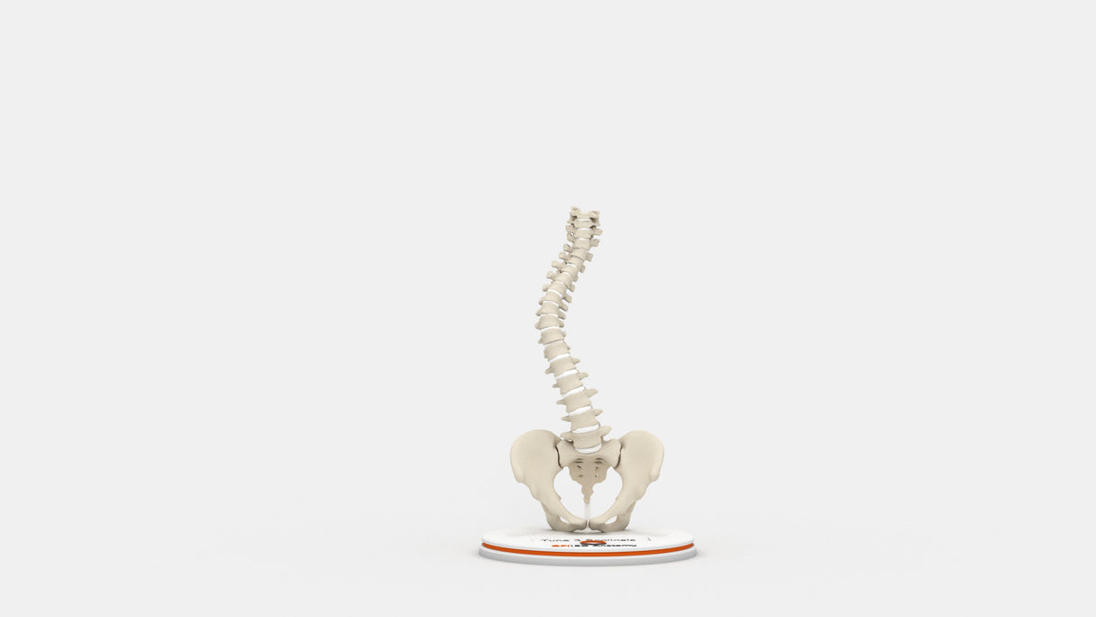 Scoliosis Type-3 Model 1