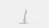 Scoliosis Type-3 Model 1