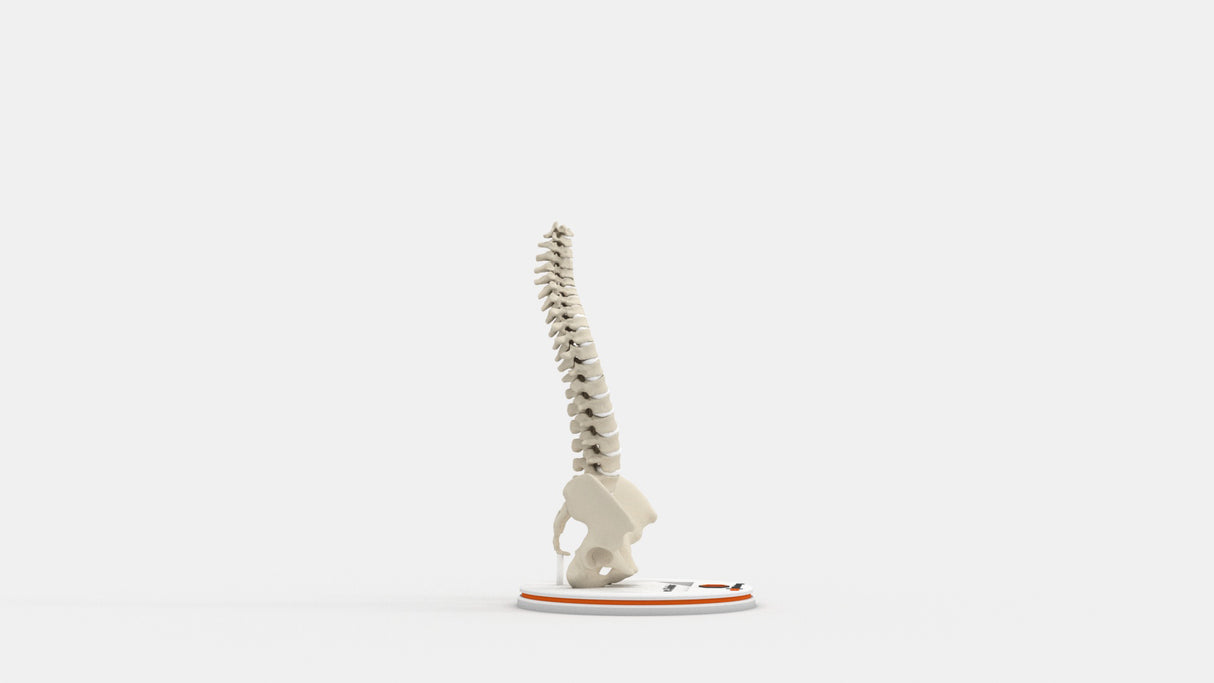 Scoliosis Type-3 Model 1