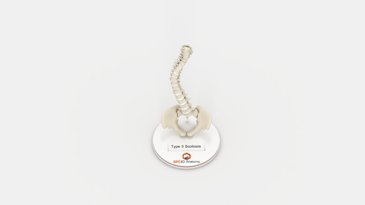 Scoliosis Type-3 Model 1