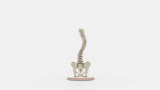 Scoliosis Type-3 Model 2
