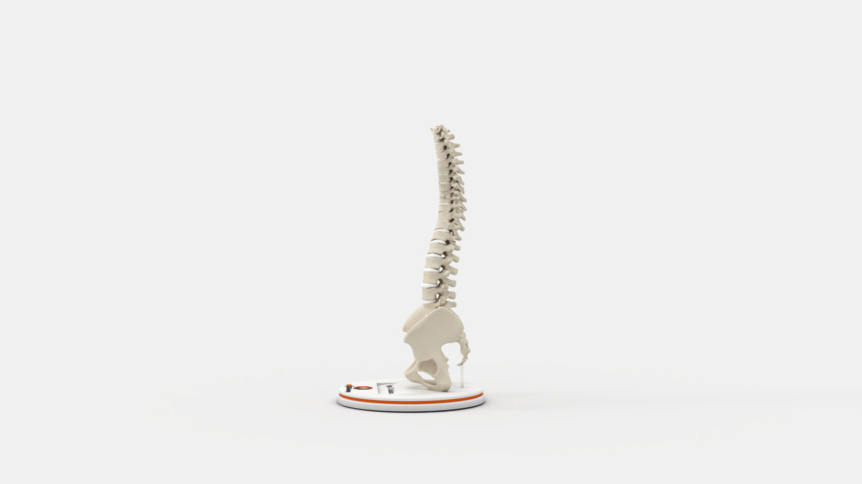 Scoliosis Type-3 Model 2
