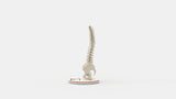 Scoliosis Type-3 Model 2