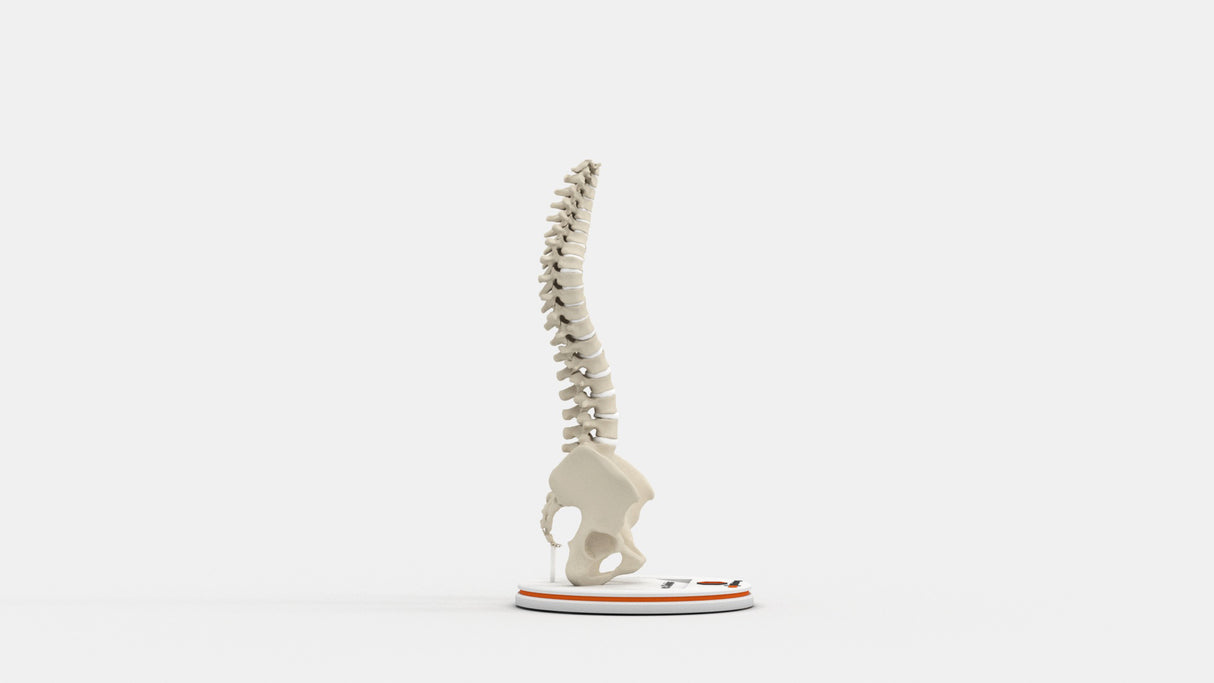 Scoliosis Type-3 Model 2
