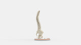 Scoliosis Type-3 Model 2
