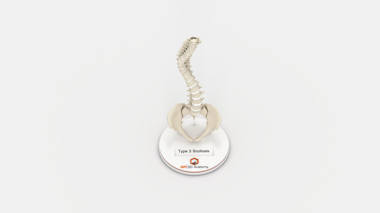 Scoliosis Type-3 Model 2