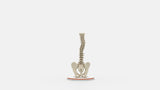 Scoliosis Type-4 Model 1