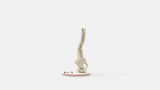 Scoliosis Type-4 Model 1