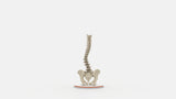Scoliosis Type-5 Model 1