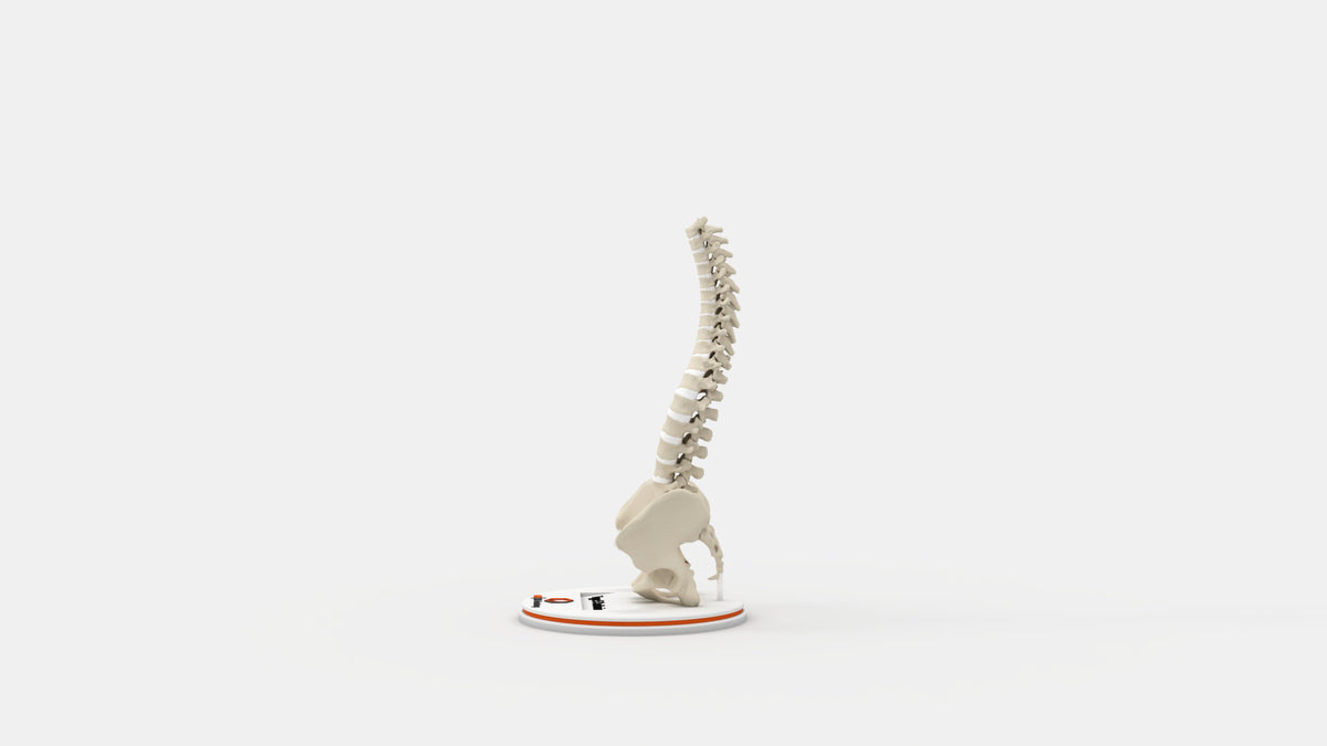 Scoliosis Type-5 Model 1