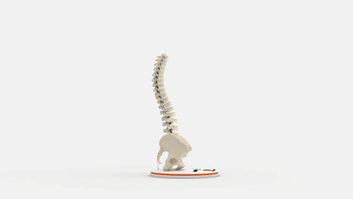 Scoliosis Type-5 Model 1