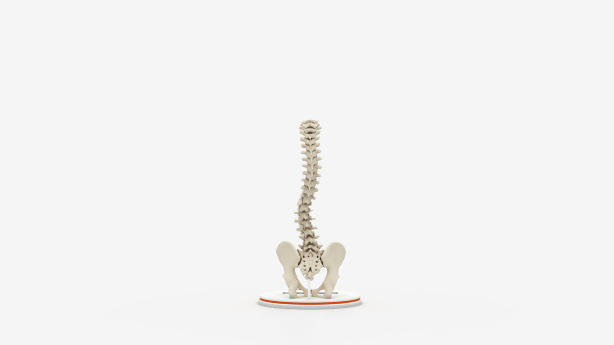 Scoliosis Type-6 Model 1