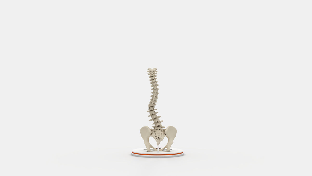 Scoliosis Type-6 Model 2